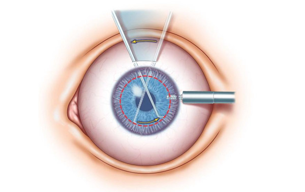 临沂白内障免费政策2025年全新解读：覆盖人群、申请流程全公开，速看是否符合条件