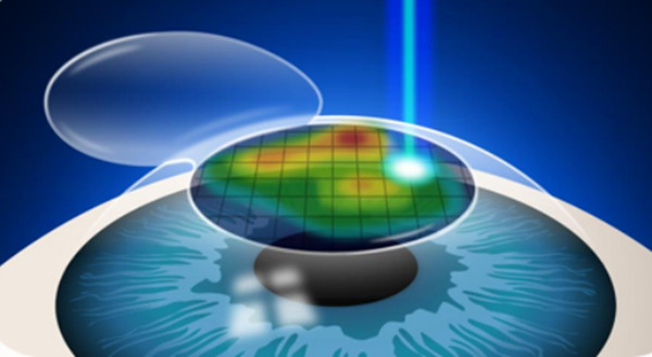   绵阳万江眼科医院近视手术价格表更新,2025年全激光手术降价15%!学生党也能轻松摘镜