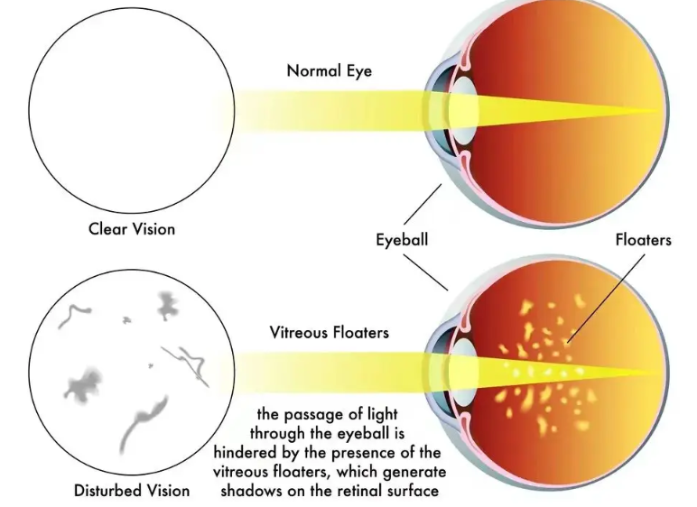 王乐今后巩膜加固术患者真实反馈