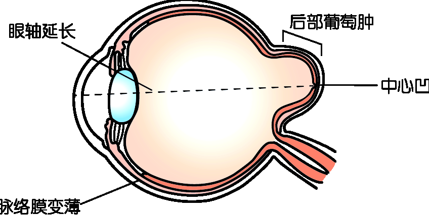 王乐今后巩膜加固术的患者手术过程分享