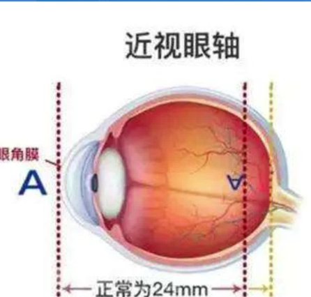 王乐今后巩膜加固术费用及患者评价