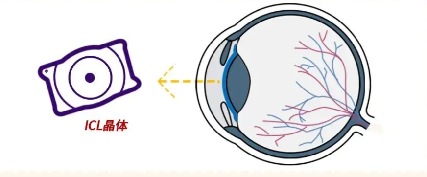 德视佳眼科icl手术患者体验
