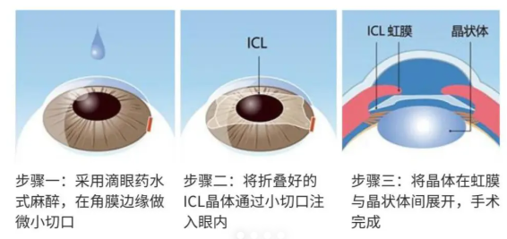 蔡磊琳做icl手术前要问清楚哪些事