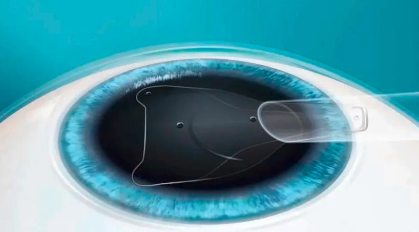 蔡磊琳是icl认证医生吗？真实调查结果与用户亲测反馈分享