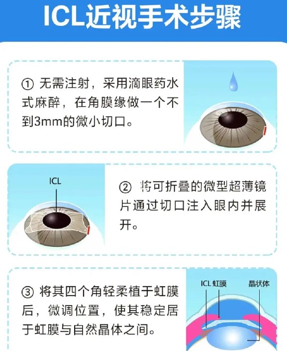 蔡磊琳做icl手术前要问清楚哪些事