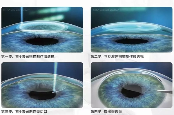 一、报考军校眼睛近视做什么手术？ICL不行！全飞秒SMILE是理想选择