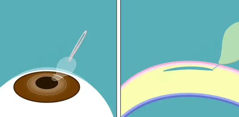 四、报考军校眼睛近视手术后的注意事项