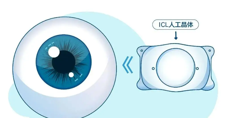 乌鲁木齐普瑞眼科医院吴生泉icl晶体植入好评高！3000+例零感染，术后裸眼视力1.2稳了！