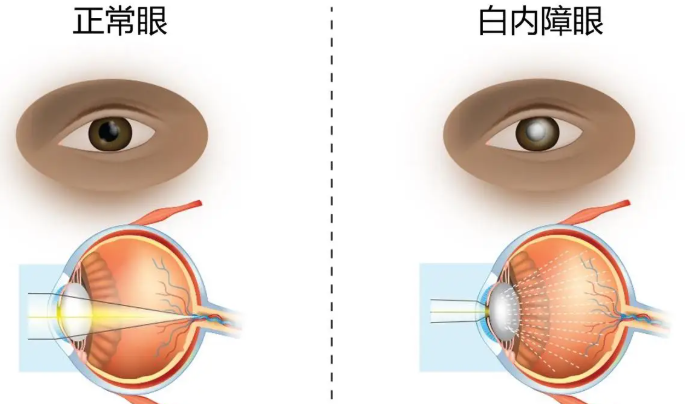 二、 朱思泉眼科手术太稳了！实证为什么复杂病例都要找他？www.sanjiaojingti.com