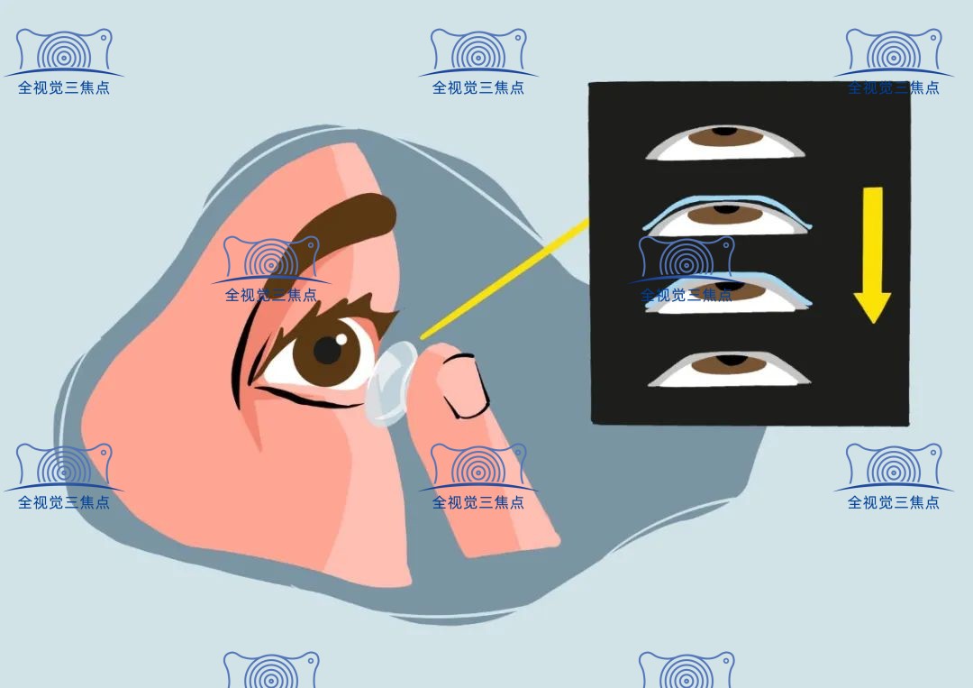 为什么医生不建议角膜塑形镜