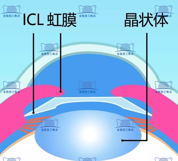 近视手术大概多少费用sanjiaojingti.com