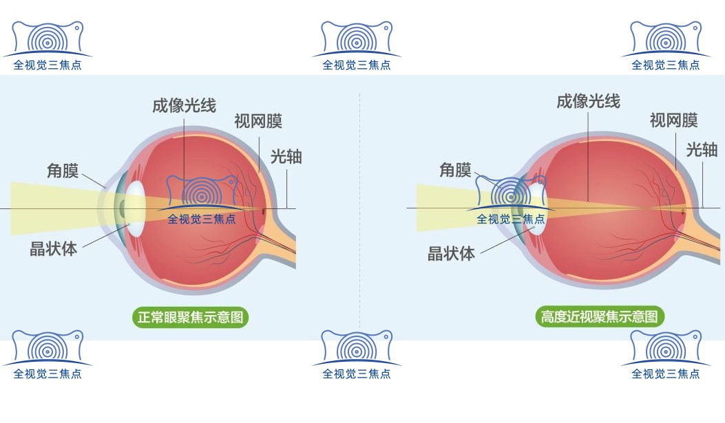 高度近视