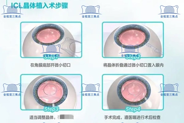 晶体植入步骤www.sanjiaojingti.com