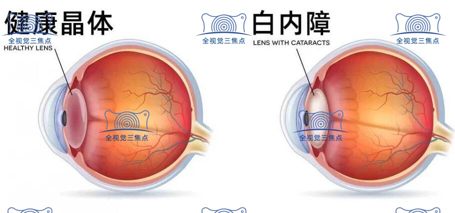健康晶体和白内障晶体对比