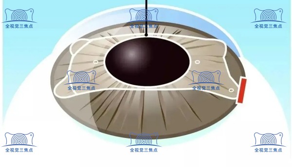 1300度/1500度的高度近视适合做哪种近视手术