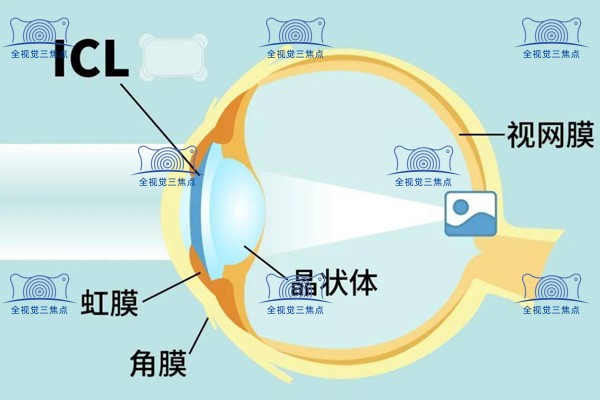 晶体植入的位置图