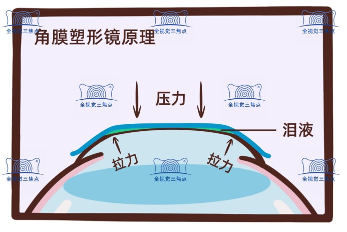 角膜塑形镜品牌排行榜中哪个好sanjiaojingti.com
