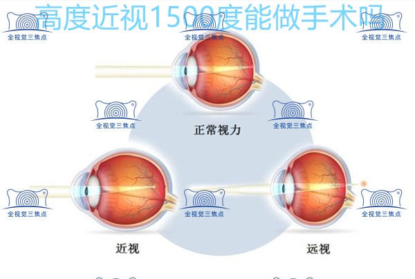 高度近视1500度能做近视手术吗