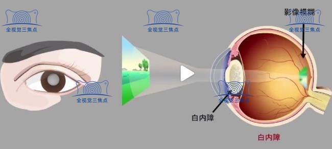 白内障人工晶体优缺点介绍