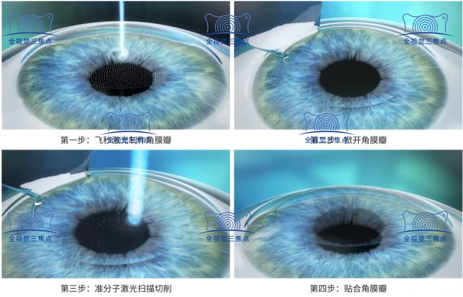 全飞秒激光手术过程www.sanjiaojingti.com
