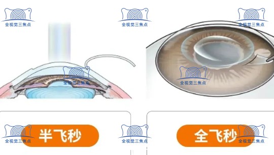 飞秒手术
