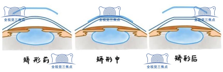 控制度数好的话优选角膜塑形镜