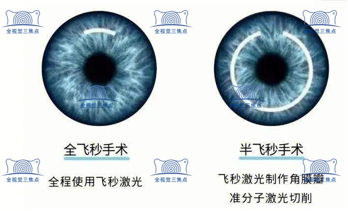 全飞秒和半飞秒的手术区别挺大的www.sanjiaojingti.com
