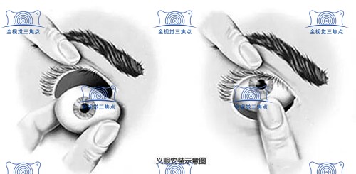 高分子义眼片优势