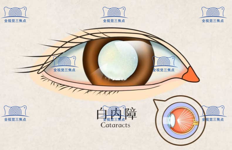 老年人白内障手术免费政策2023-揭秘农村白内障免费骗局