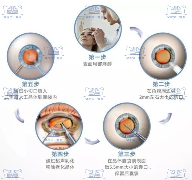 高端蔡司三焦点人工晶体植入手术过程