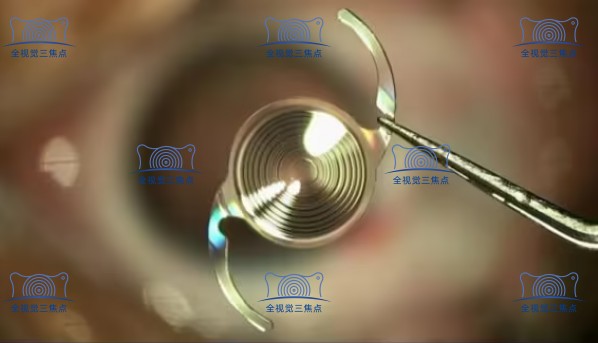 强生跃无级连续视程人工晶体价格多少