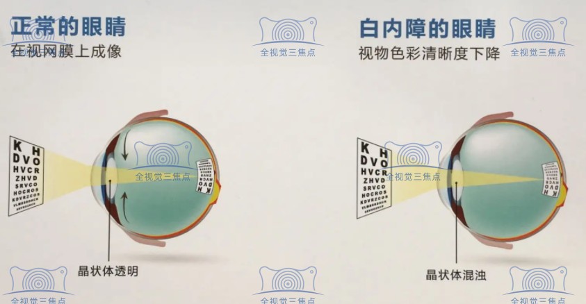 白内障术前视物不清晰