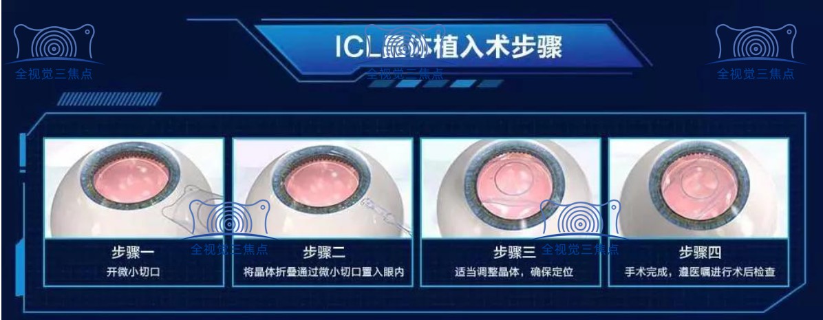 ICL晶体二次更换手术过程和步骤