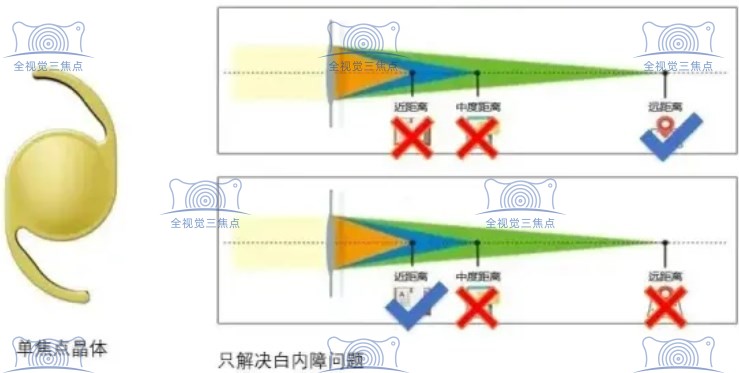白内障用单焦好还是多焦晶体好