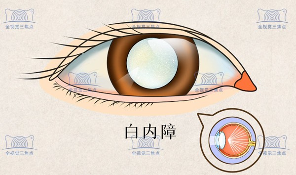 白内障人工晶体和近视眼人工晶体icl的区别