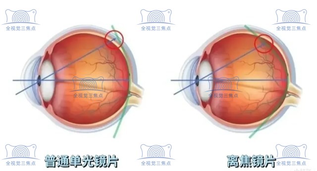 离焦镜片和普通镜片的成像