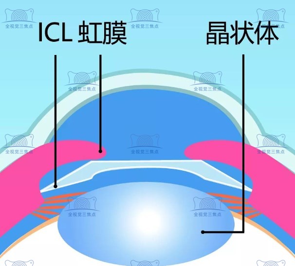 icl晶体植入的优缺点