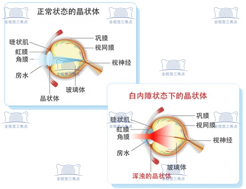 做白内障手术用的人工晶体有几种类型