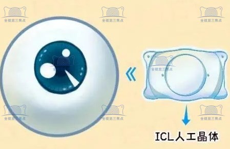 icl晶体植入手术的利与弊www.sanjiaojingti.com