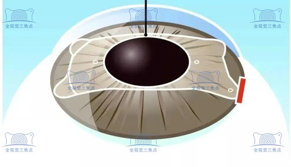 近视眼icl晶体植入手术价格表