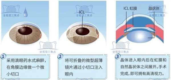 近视眼人工晶体植入手术能报销吗