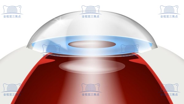 近视眼人工晶体植入手术价格表sanjiaojingti.com