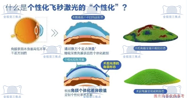 个性化半飞秒手术