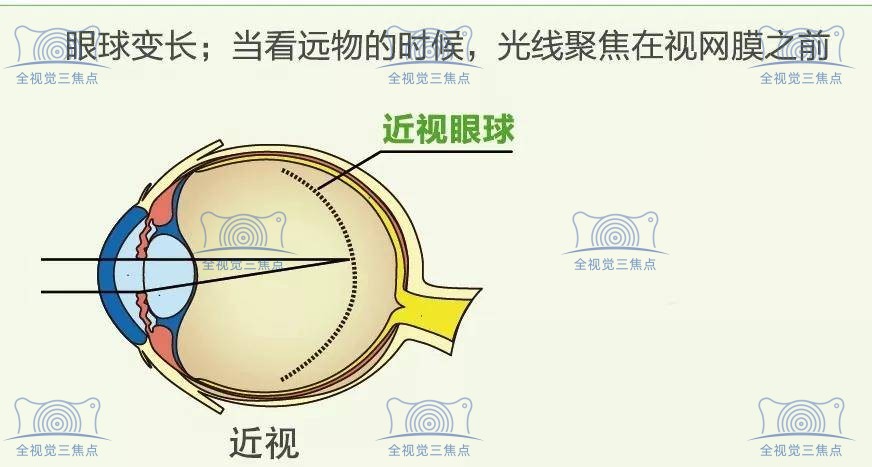 青少年眼睛近视矫正哪种技术好