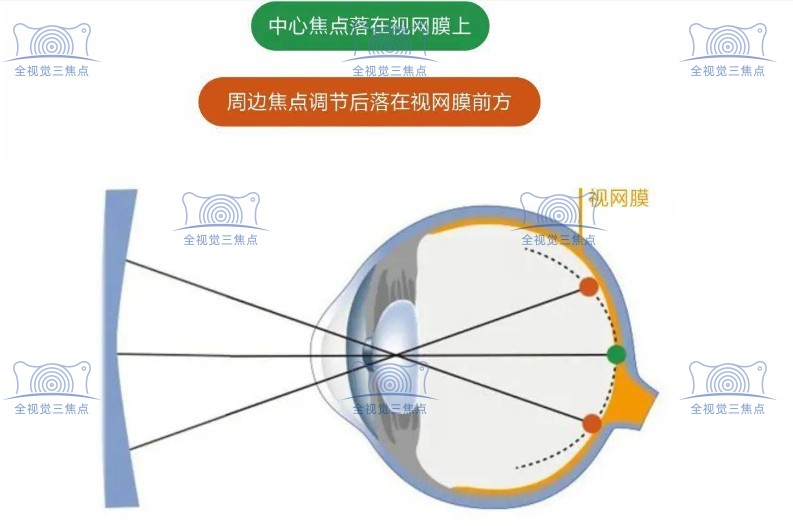 离焦镜控制近视增长原理