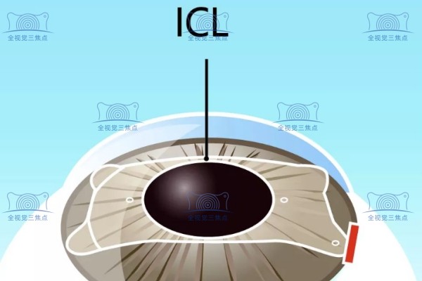 晶体植入近视眼手术能维持多少年有异常需取出