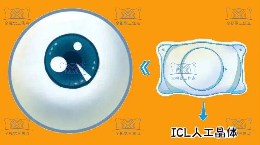 icl人工晶体植入手术