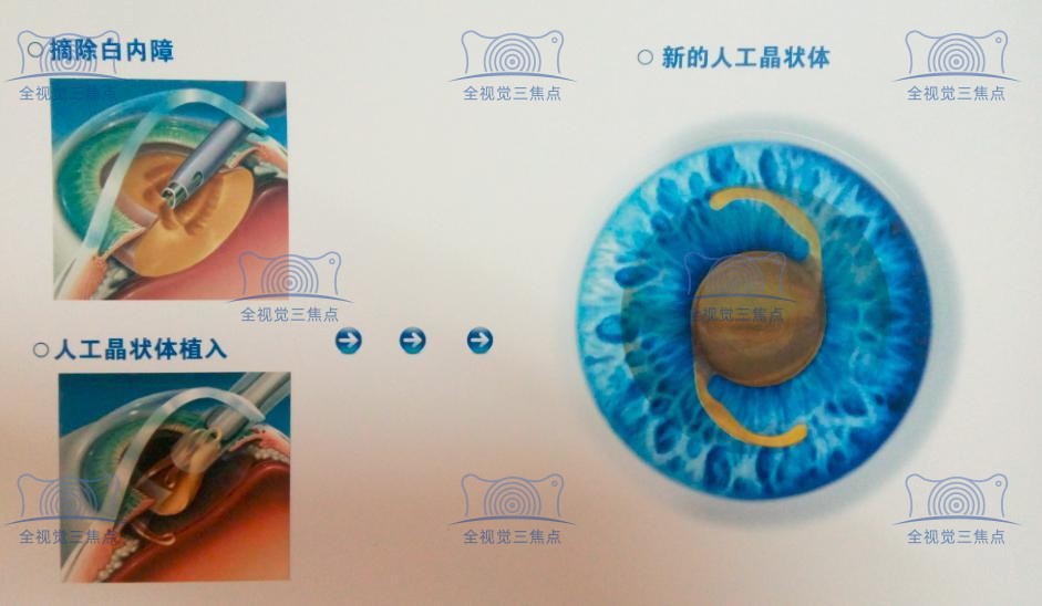 白内障换晶体后遗症