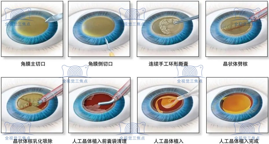 白内障晶体植入手术过程www.sanjiaojingti.com