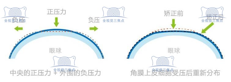 韩国露晰得角膜塑形镜成效好